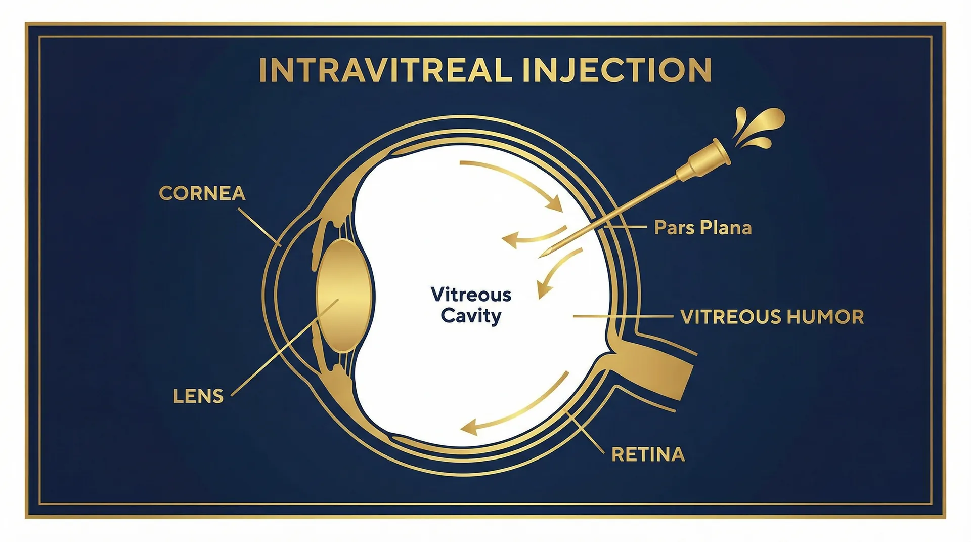 Injeção intravítrea — tratamento de doenças da retina — Drudi e Almeida